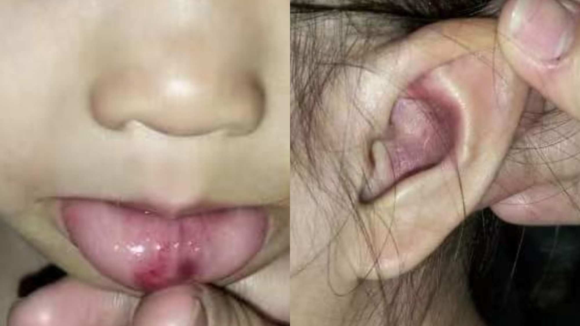 Kanak-kanak alami luka pada gegendang telinga, bibir didera teman lelaki ibu