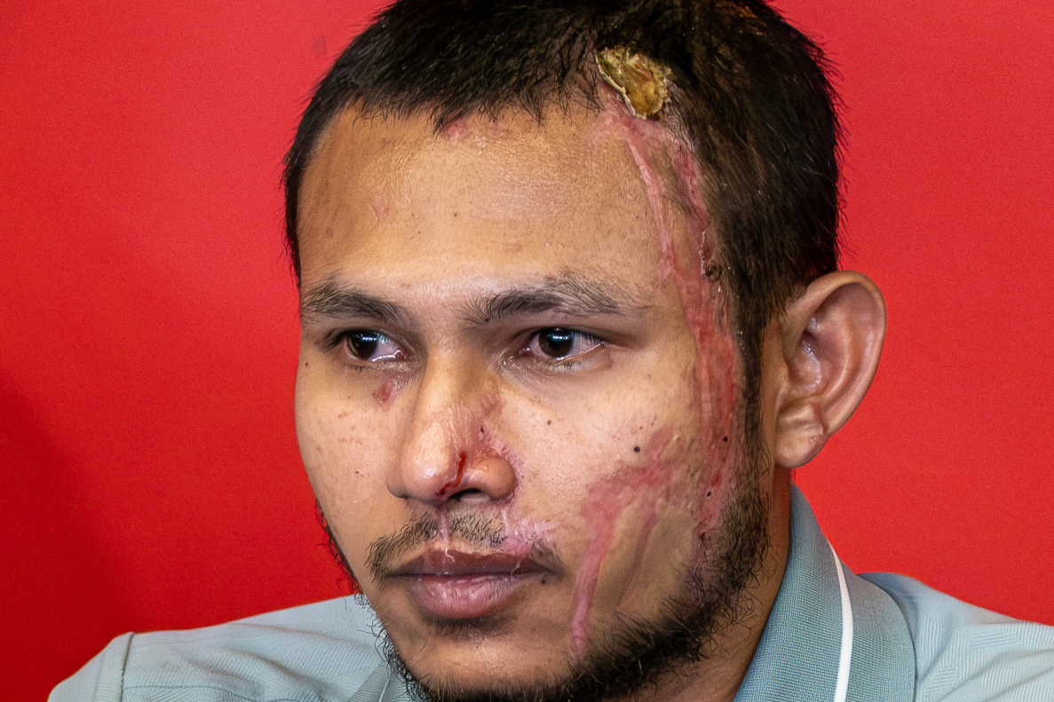 Photo of the day: Faisal Halim makes tearful first public appearance since acid attack