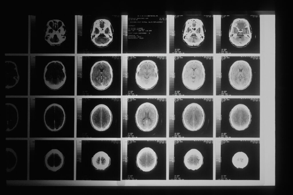 MRI-brain-scan-unsplash